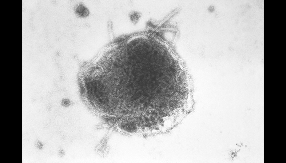 Confirmed Measles Case Stops in FP